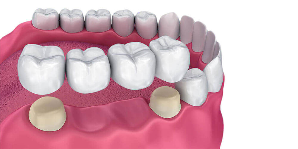 Dental Bridges Hamilton