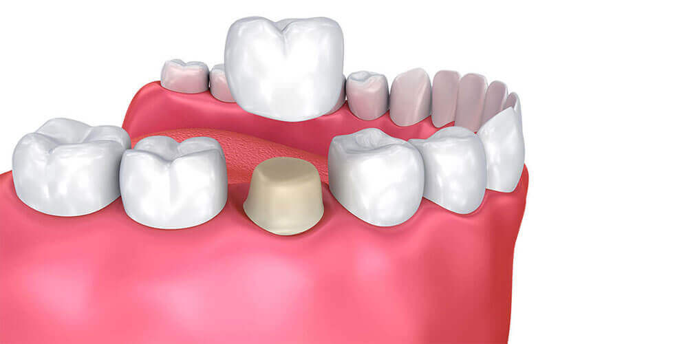Dental Crowns Hamilton