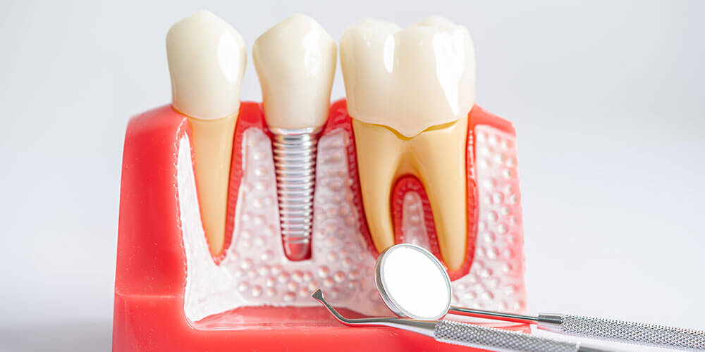 Dental Implants Hamilton