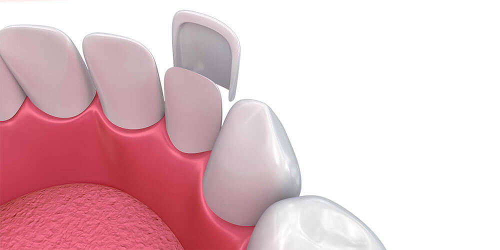 Dental Veneers Hamilton